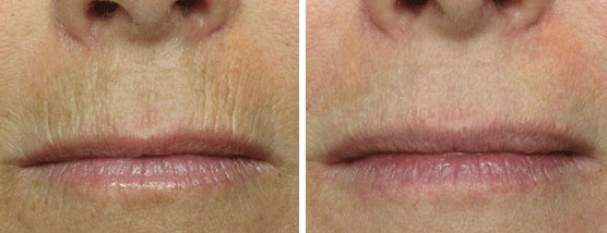 Морщины вокруг губ: фото до и после коррекции