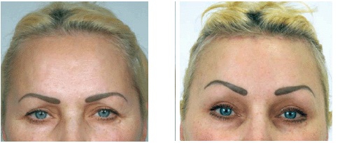 Фото до и после коррекции опущения бровей