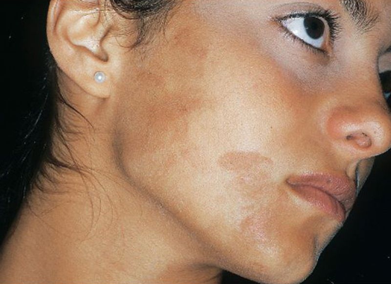 Пигментные пятна на щеках, причина – нарушения в работе печени
