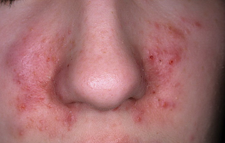 Себорейный дерматит на лице (щеки и носогубные складки)