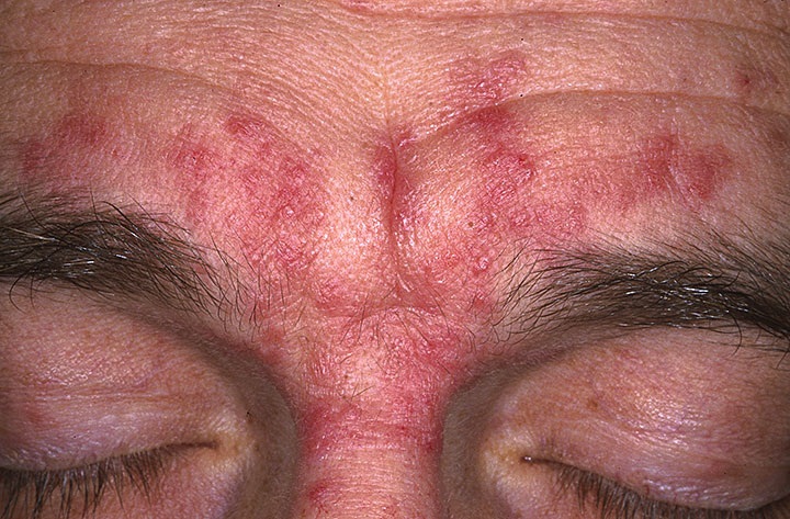 Себорейный дерматит на лице (межбровная зона и лоб)