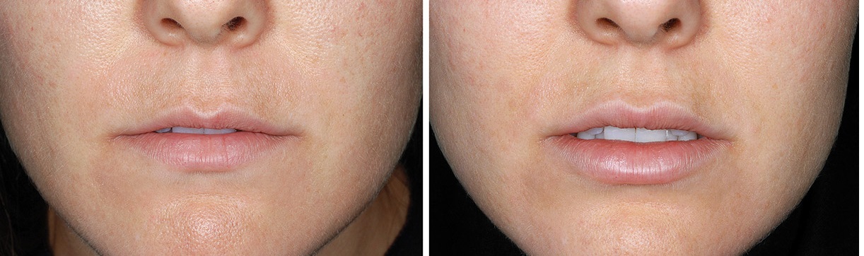 Увеличение тонких губ с помощью инъекций гиалуронового филлера: фото до и после