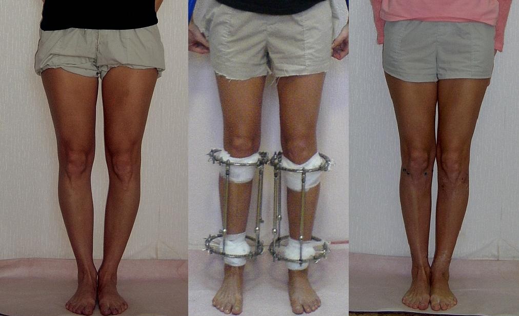 После хирургического лечения варусной деформации голени пациенту придется несколько месяцев носить на ногах аппарат Елизарова