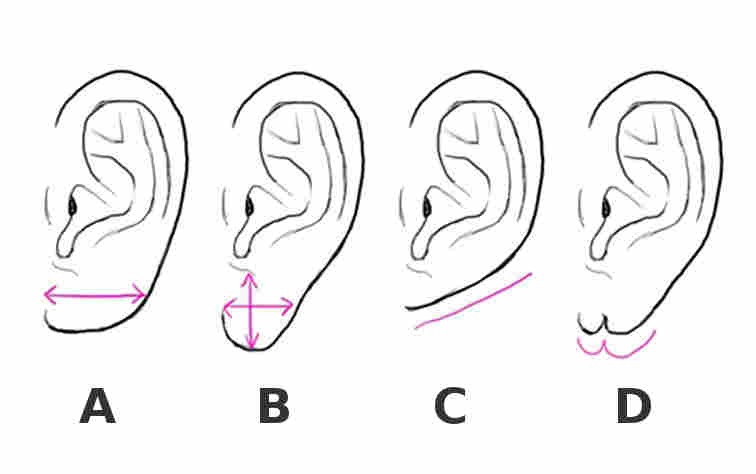 Разные формы мочек ушных раковин; C – приросшая мочка