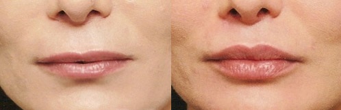 Увеличение губ: фото до и после липофилинга
