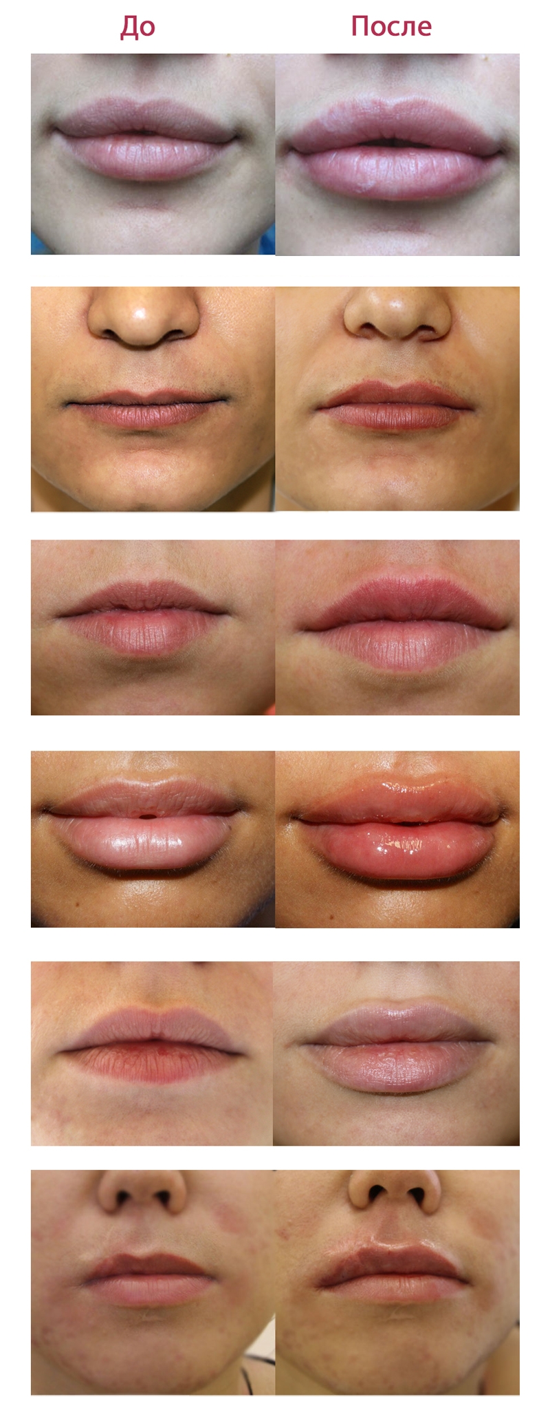 коррекция губ гиалуроновой кислотой фото