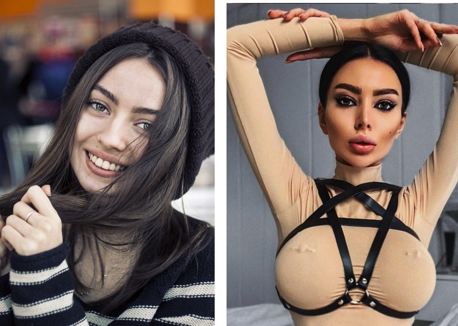 Алена Омович: фото до и после пластической операции