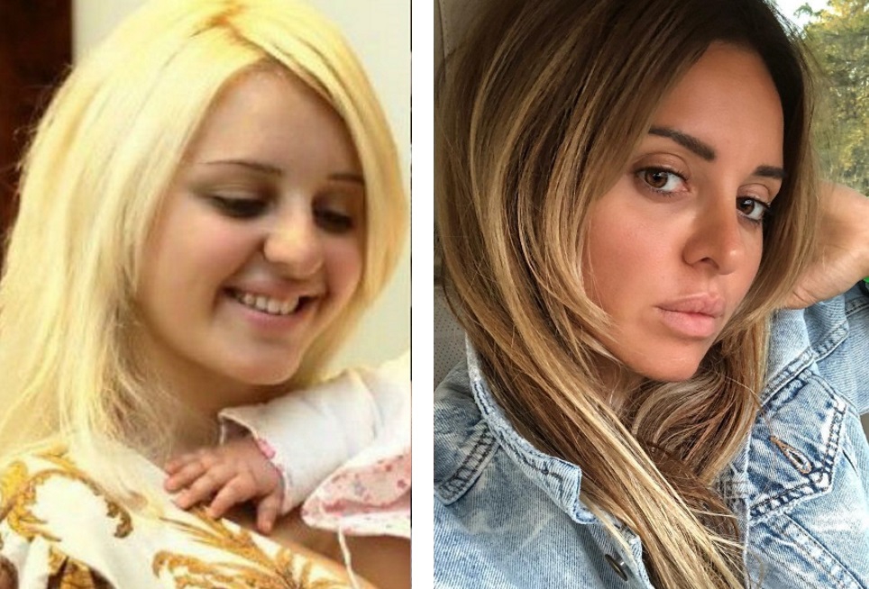 Анжелика Ревва до и после пластики носа и контурной пластики губ