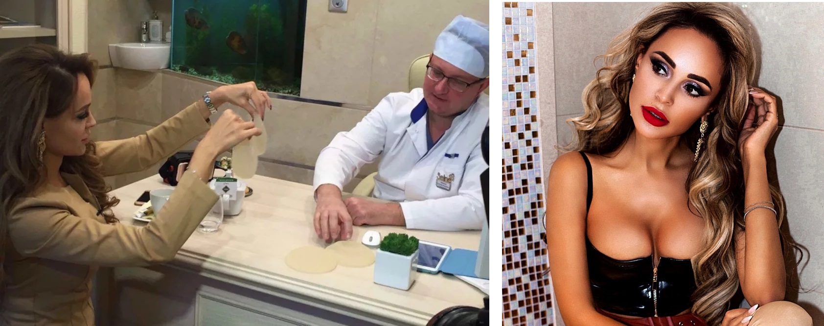 Пластика груди Анны Калашниковой: слева – певица выбирает размер имплантатов, справа – возможно, результат маммопластики