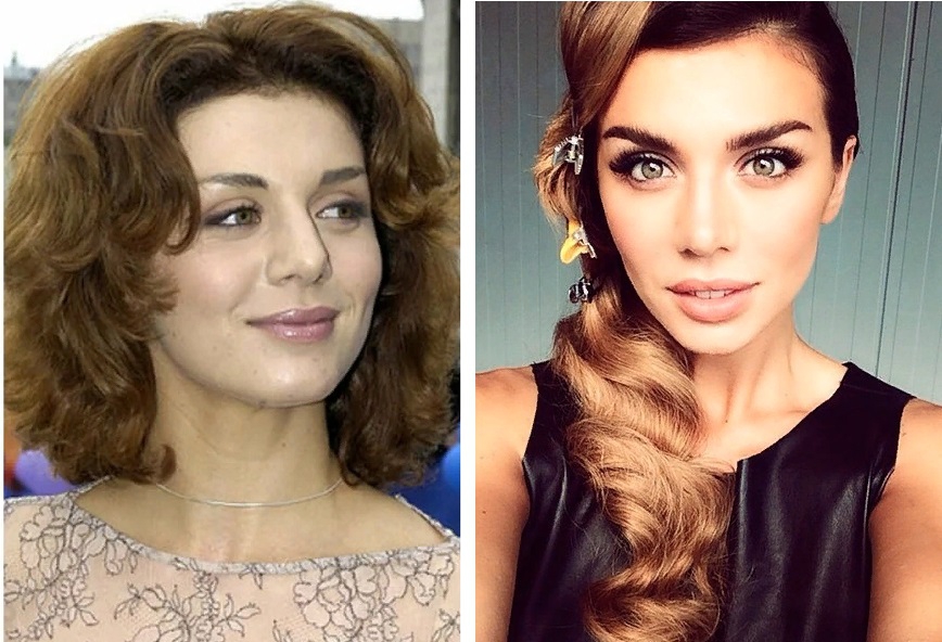 На фото Анна Седокова до и после пластики