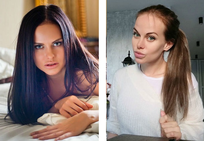 Аурика Алехина до и после контурной пластики губ