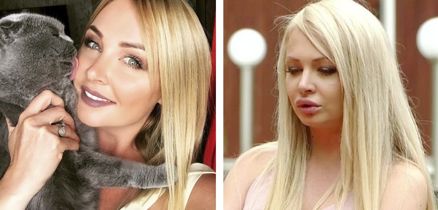  Дарья Пынзарь до и после контурной пластики губ