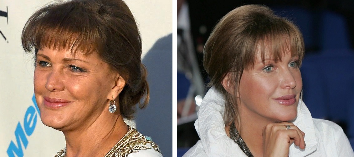 Сравните фото Елены Прокловой до и после пластики