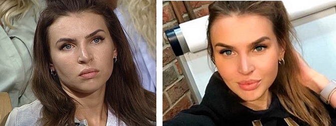 Элла Суханова до и после пластики носа