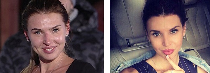 Элла Суханова: фото до и после пластики лица