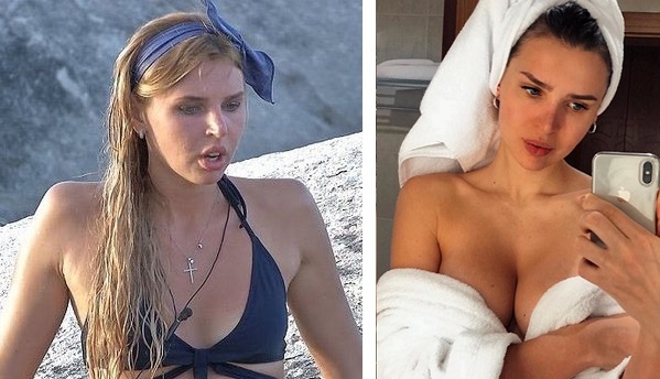 Элла Суханова сделала маммопластику: фото до и после операции