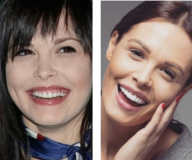 Мария Горбань зубы: фото до и после