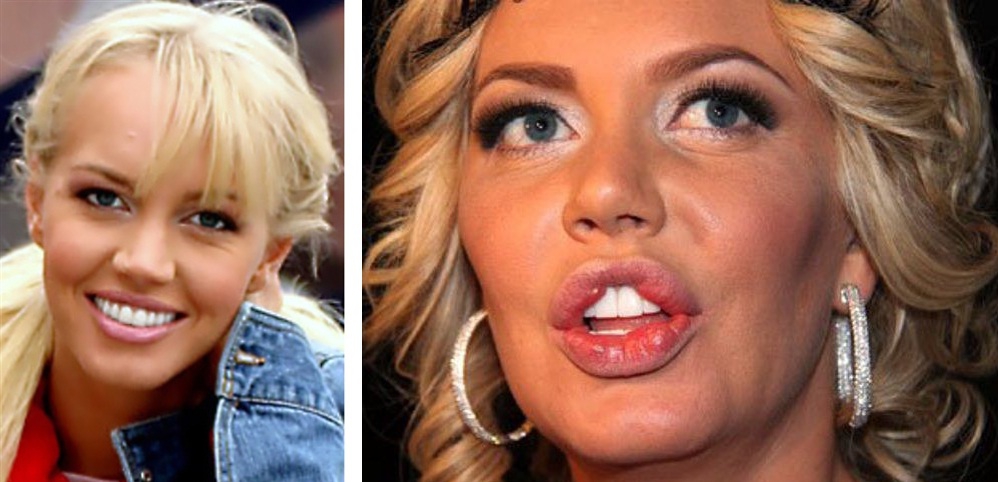 Малиновская до и после пластики губ (хейлопластики)