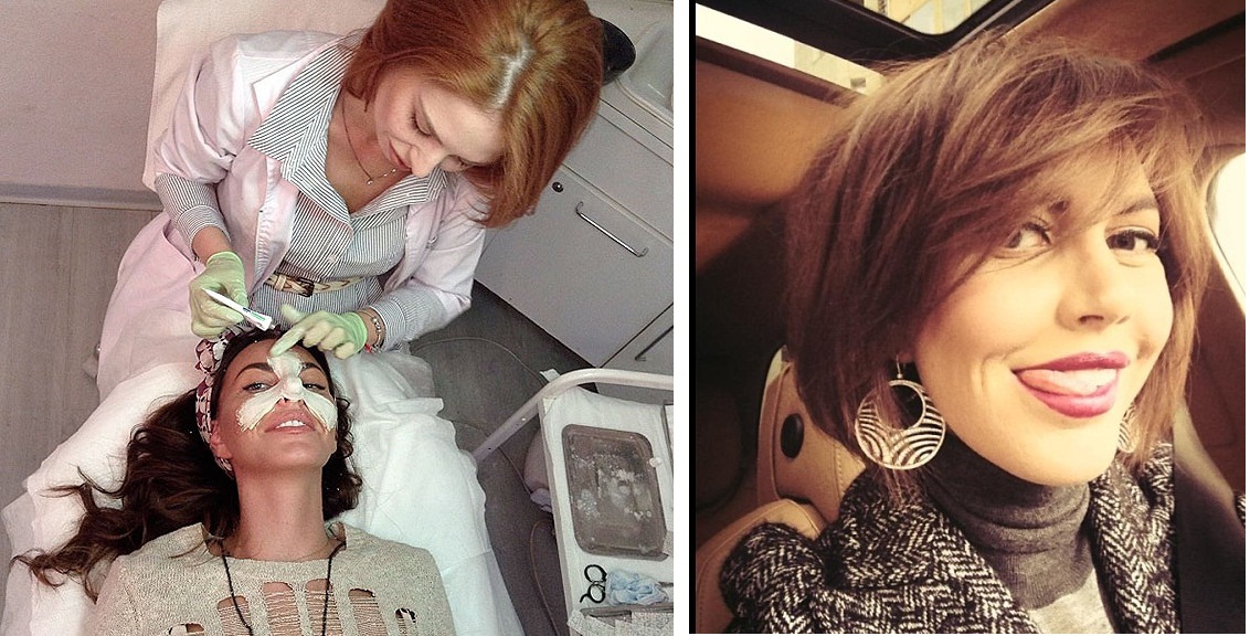 Малиновская во время и после безоперационной коррекции носа