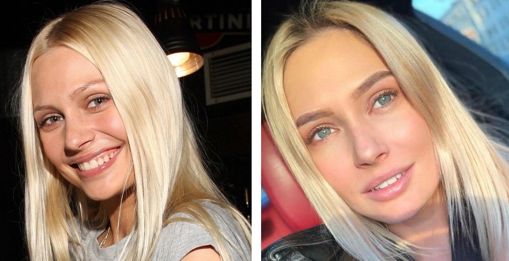 Наталья рудова до и после пластики лица фото до и после