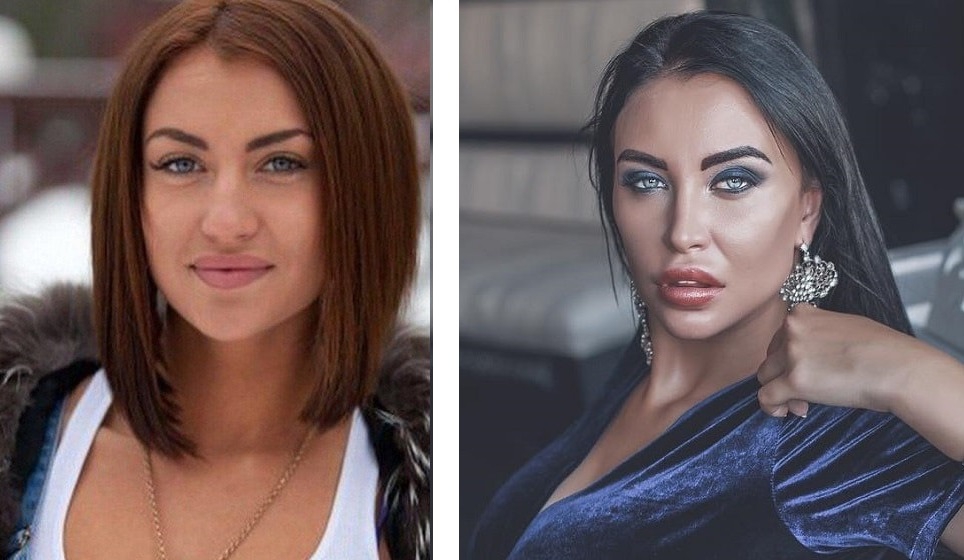 Виктория Берникова до и после пластики