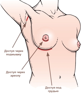 Доступы для установки импланта: подмышечный, через ареолу, под грудью