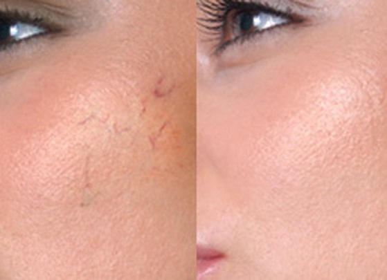 Пилинг кожи с куперозом: фото до и после