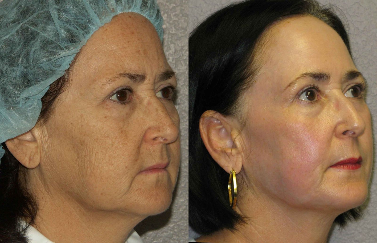 Лазерный пилинг лица: фото до и после процедуры