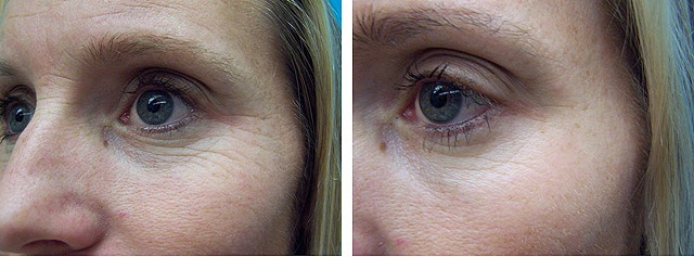 Лазерный пилинг лица: фото до и после процедуры