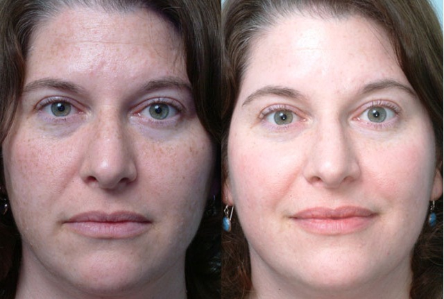 Фото пациентов до и после мезопилинга