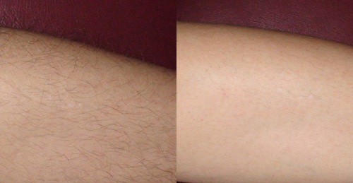 Вид кожных покровов до и после электроэпиляции
