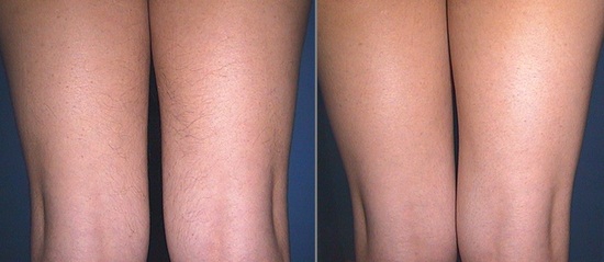Фото до и после Элос-эпиляции ног