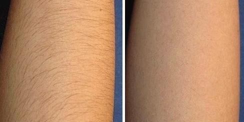 Вид кожи до и после фотоэпиляции