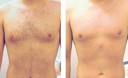 Лазерная эпиляция груди - фото до и после