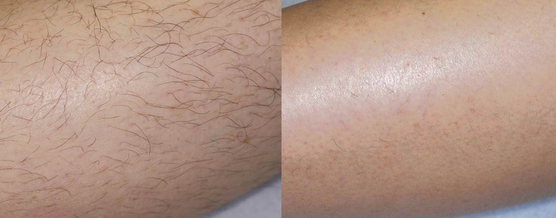 Вид кожи до и после лазерной эпиляции