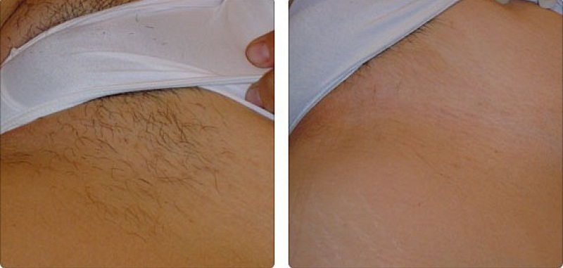 Шугаринг: фото до и после депиляции зоны бикини