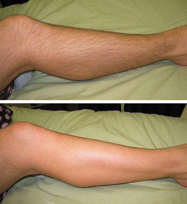 Депиляция воском ног: фото до и после процедуры