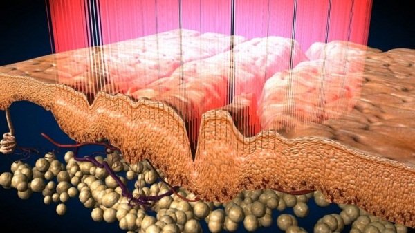 Лазерная наноперфорация для обновления кожи