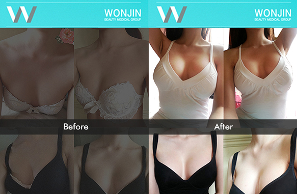 Маммопластика фото до и после в корейской клинике Вонджин