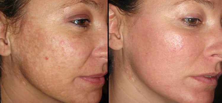 Фото пациентов до и после лечения акне
