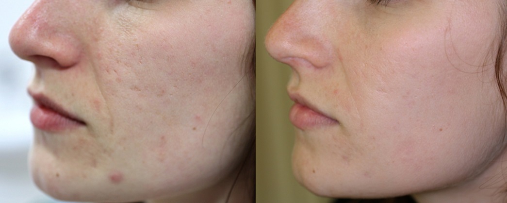 Шрамы и рубцы после акне: фото до и после процедур удаления