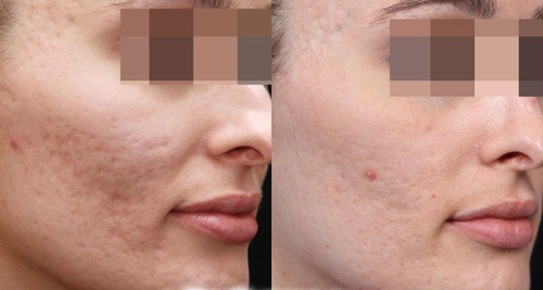 Шрамы и рубцы после акне: фото до и после процедур удаления