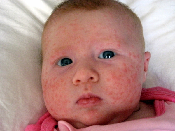 Прыщики на лице, груди, спине младенца появляются в первый месяц жизни и, как правило, проходят к полугоду