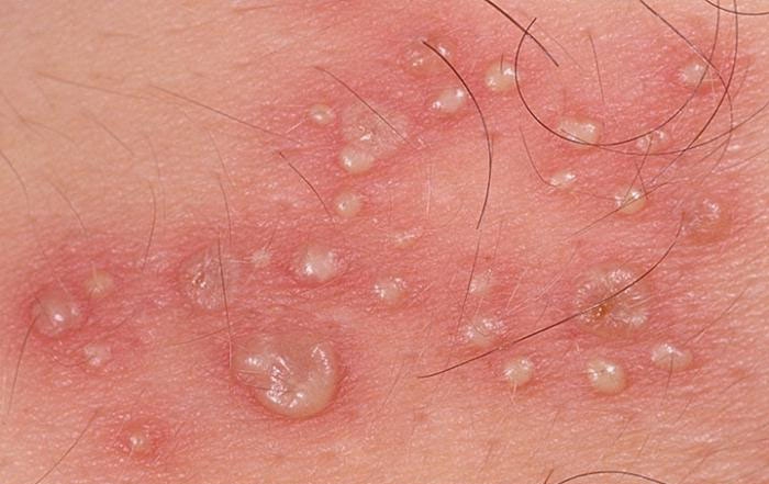 При аллергическом дерматите на коже образуются везикулы (пузырьки с жидкостью)