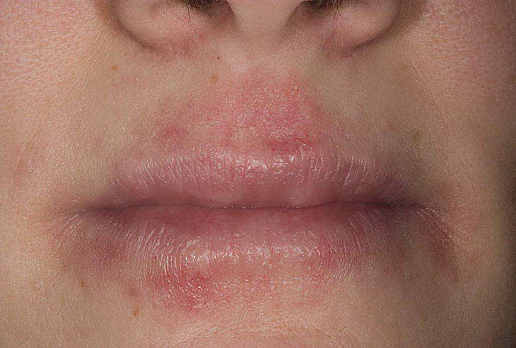 Аллергический дерматит на лице