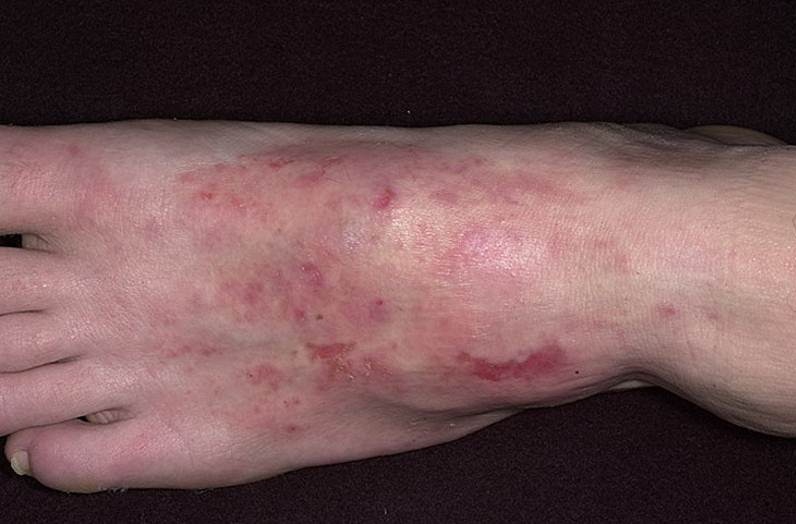  Аллергический дерматит на ногах
