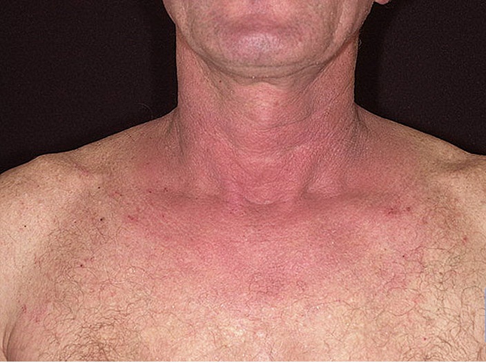 Аллергический дерматит на шее: для лечения используют антигистаминные препараты и мази