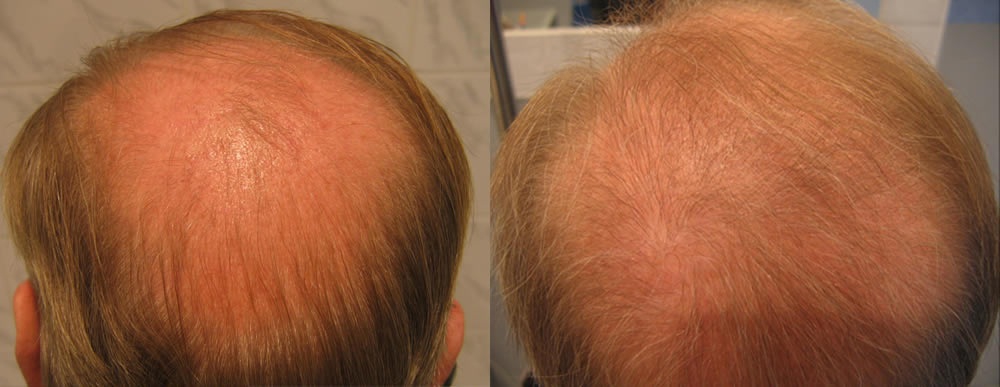 Андрогенная алопеция: фото до и после пересадки волос