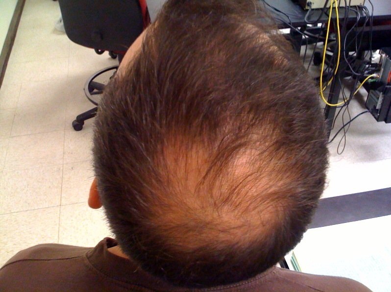 Андрогенная алопеция у мужчин: волосы в теменной зоне постепенно перерождаются в пушковые