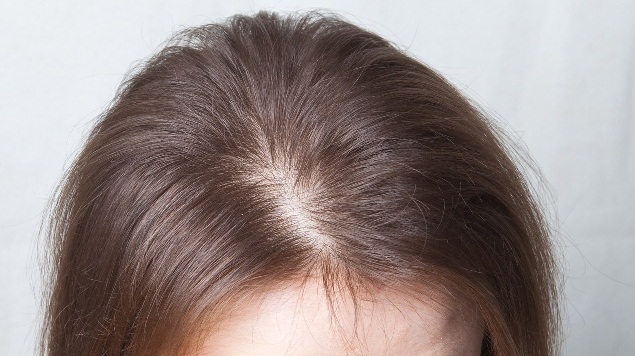 У женщин андрогенная алопеция начинается с выпадения волос в области пробора